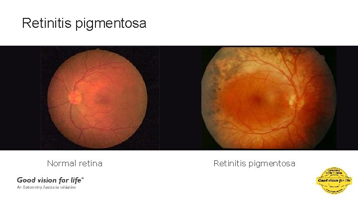 Retinitis pigmentosa Normal retina Retinitis pigmentosa 