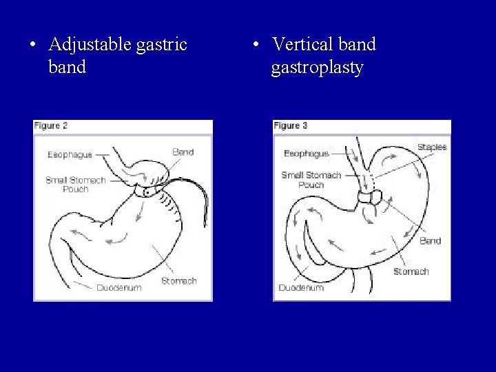  • Adjustable gastric band • Vertical band gastroplasty 