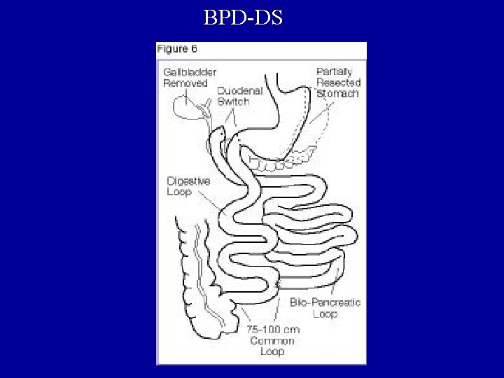 BPD-DS 