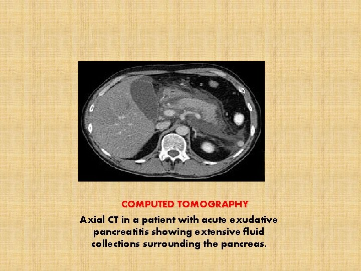 COMPUTED TOMOGRAPHY Axial CT in a patient with acute exudative pancreatitis showing extensive fluid