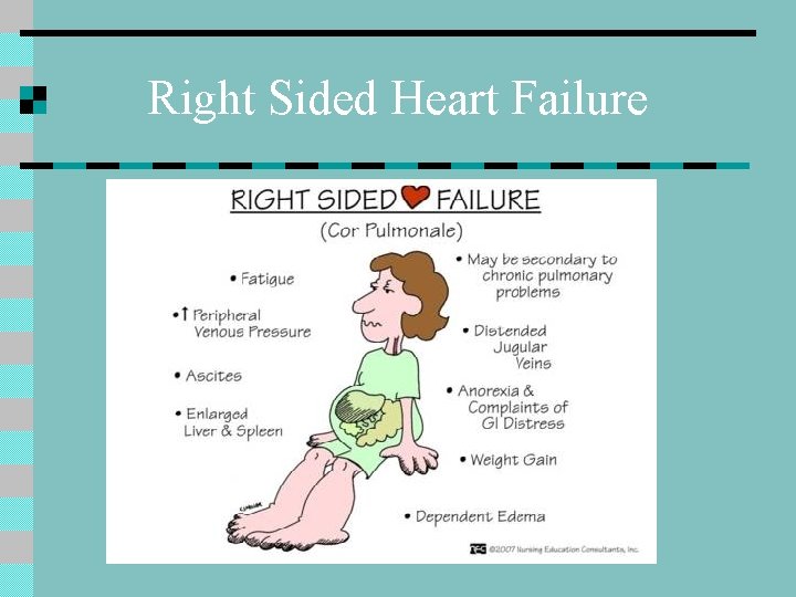 Right Sided Heart Failure 