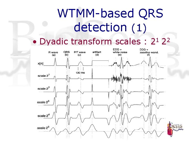 WTMM-based QRS detection (1) • Dyadic transform scales : 21 22 23 24 WTMM-based QRS detection (1) • Dyadic transform scales : 21 22 23 24