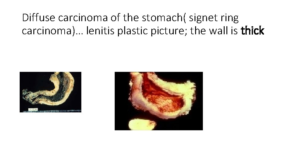 Diffuse carcinoma of the stomach( signet ring carcinoma)… lenitis plastic picture; the wall is