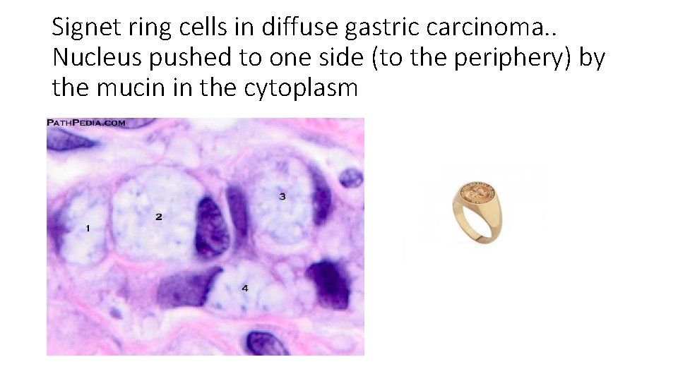 Signet ring cells in diffuse gastric carcinoma. . Nucleus pushed to one side (to