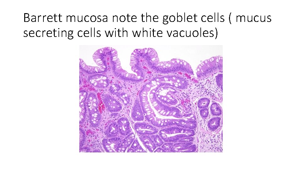 Barrett mucosa note the goblet cells ( mucus secreting cells with white vacuoles) 