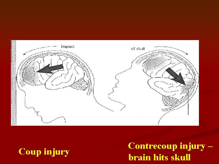 Coup injury Contrecoup injury – brain hits skull 