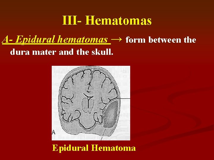 III- Hematomas A- Epidural hematomas → form between the dura mater and the skull.