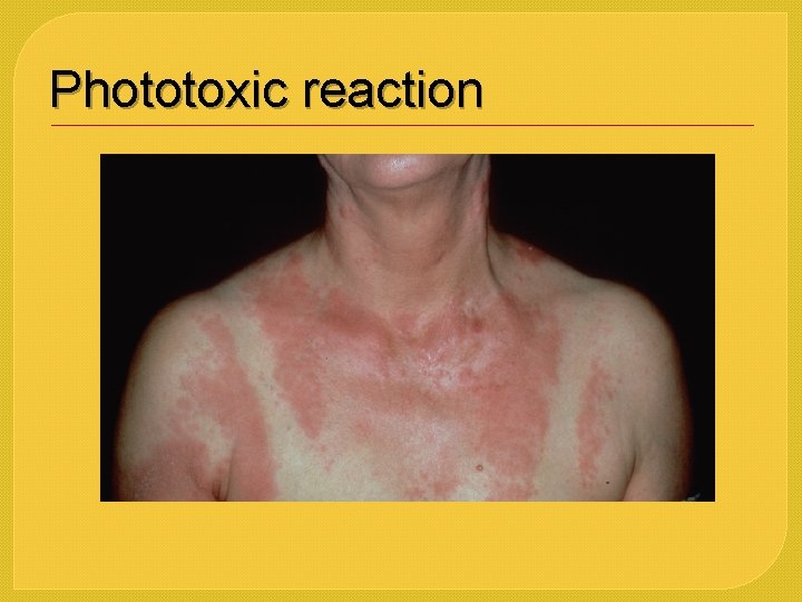 Phototoxic reaction 