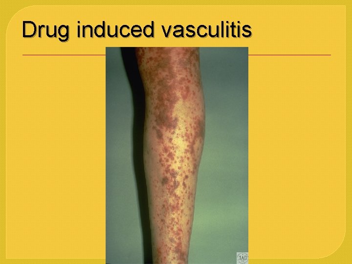 Drug induced vasculitis 