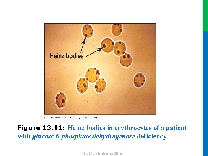 with glucose 6 -phosphate dehydrogenase deficiency. Dr. M. Alzaharna 2016 Figure 13. 11: Heinz