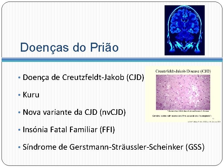 Doenças do Prião • Doença de Creutzfeldt-Jakob (CJD) • Kuru • Nova variante da