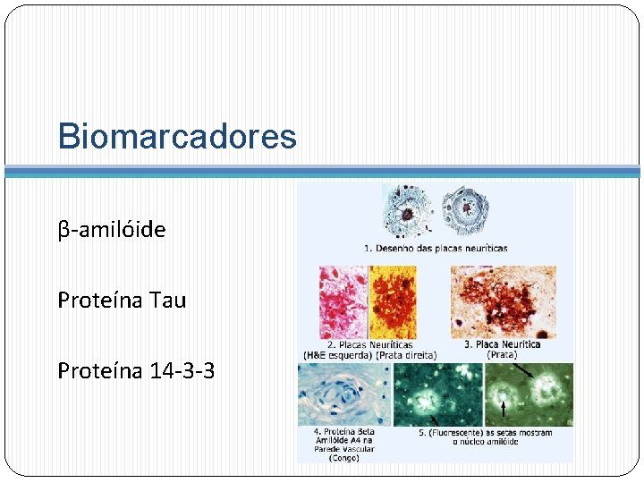 Biomarcadores β-amilóide Proteína Tau Proteína 14 -3 -3 