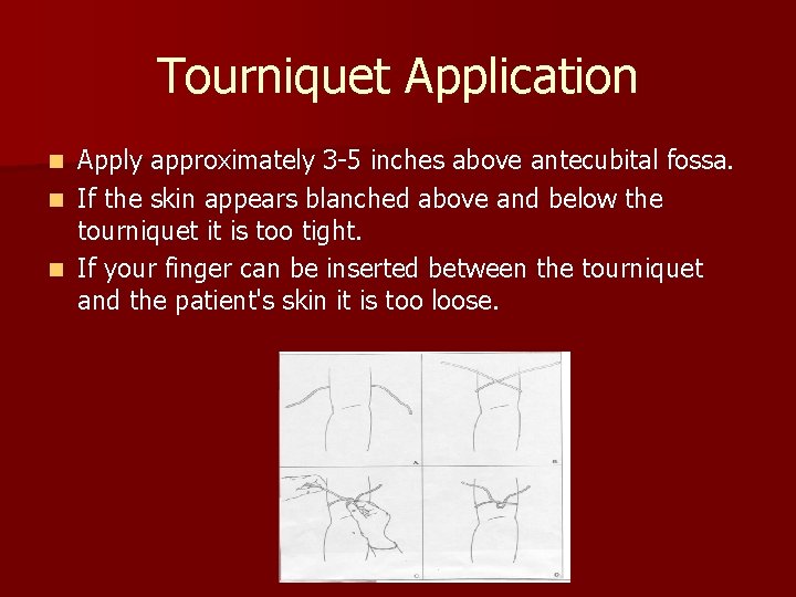 Tourniquet Application Apply approximately 3 -5 inches above antecubital fossa. n If the skin
