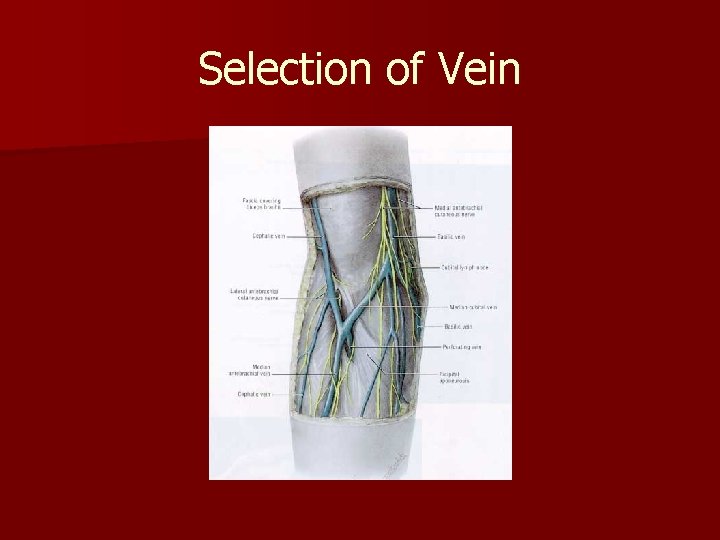 Selection of Vein 