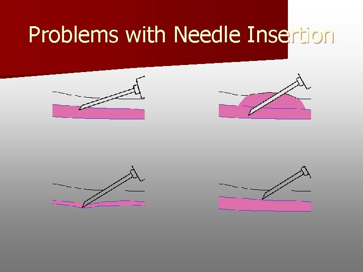 Problems with Needle Insertion 