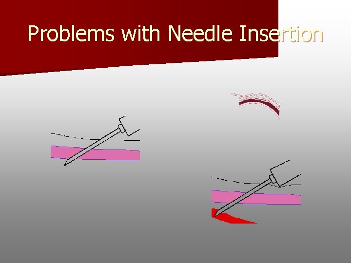 Problems with Needle Insertion 