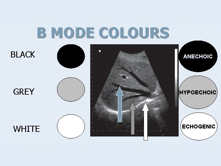 B MODE COLOURS BLACK ANECHOIC GREY HYPOECHOIC WHITE ECHOGENIC 