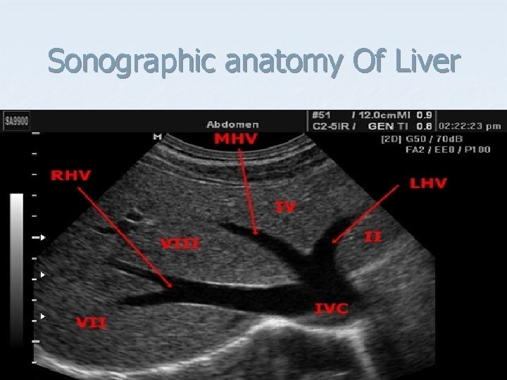 Sonographic anatomy Of Liver 