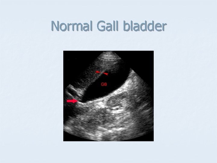 Normal Gall bladder 