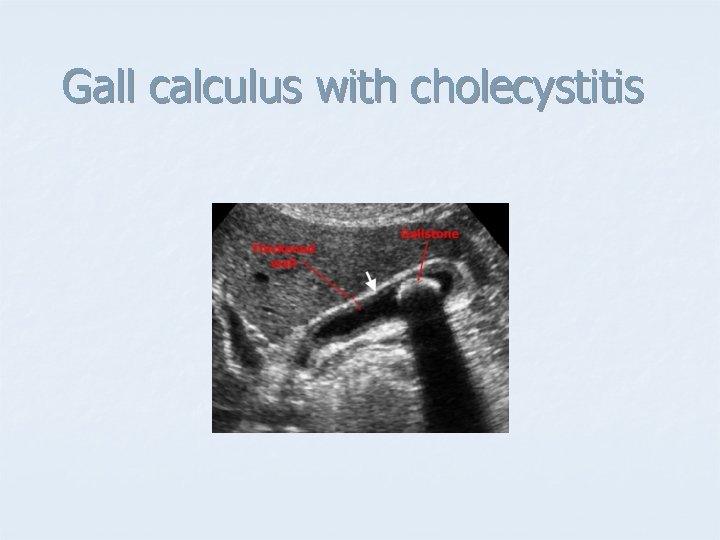 Gall calculus with cholecystitis 