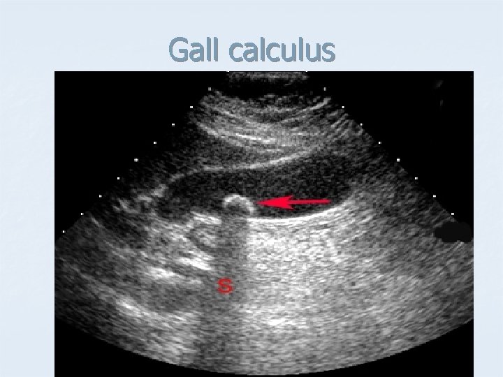 Gall calculus 