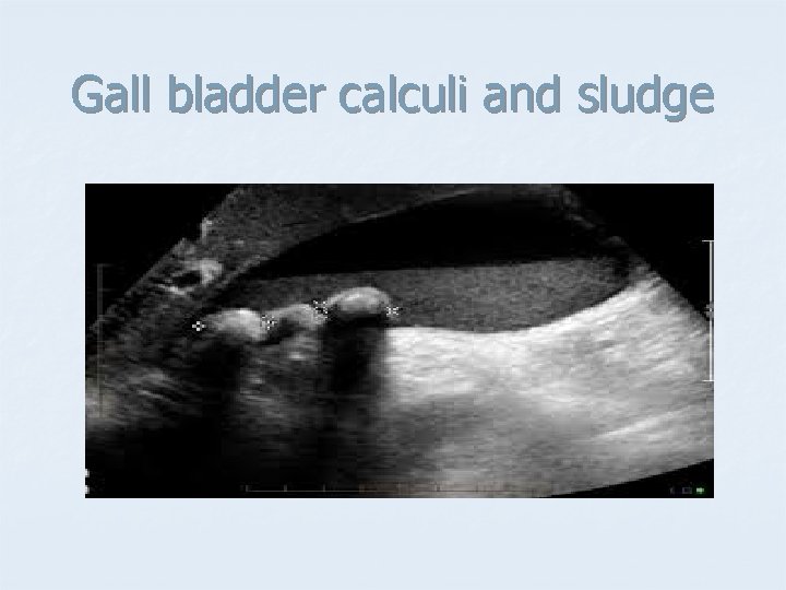 Gall bladder calculi and sludge 