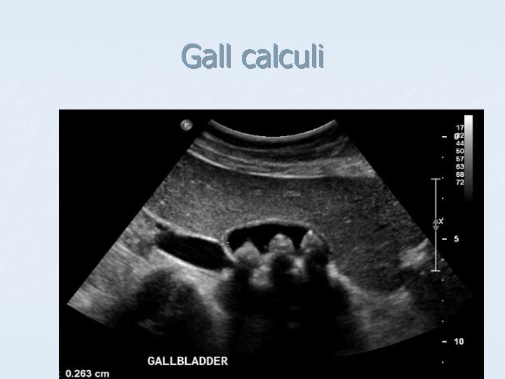 Gall calculi 