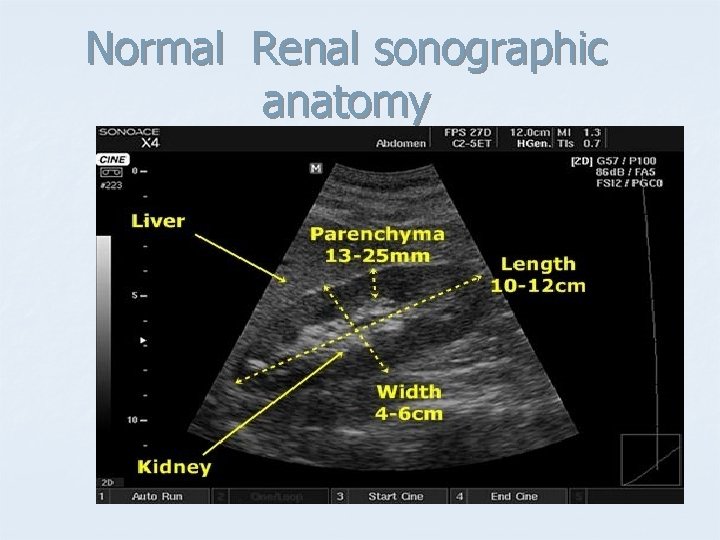 Normal Renal sonographic anatomy 