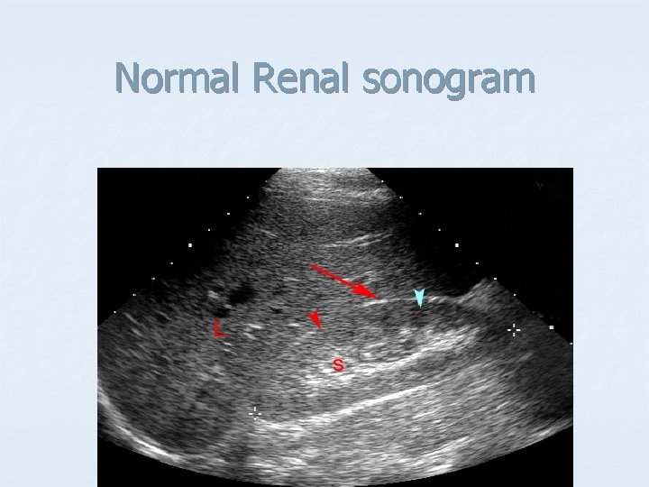 Normal Renal sonogram 