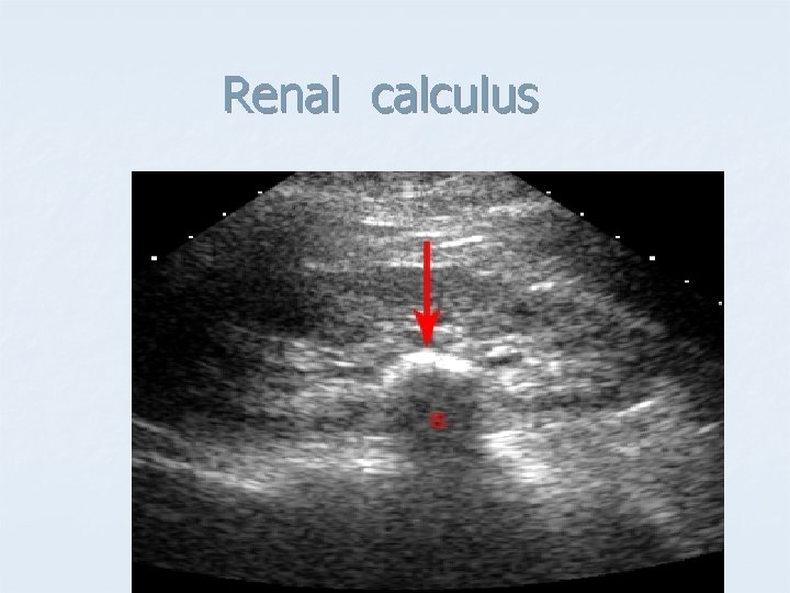 Renal calculus 