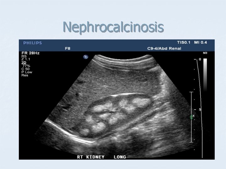 Nephrocalcinosis 