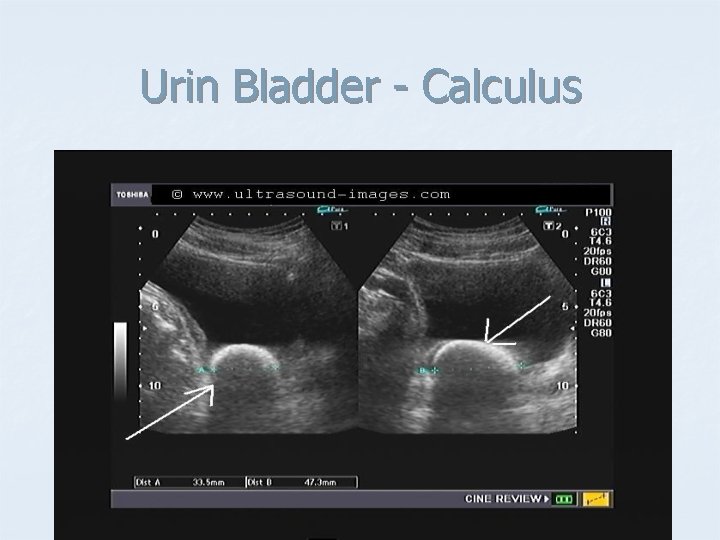 Urin Bladder - Calculus 