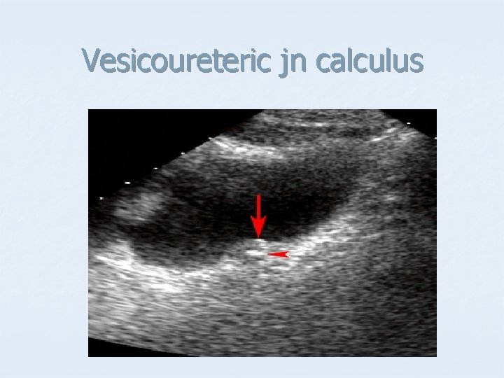 Vesicoureteric jn calculus 