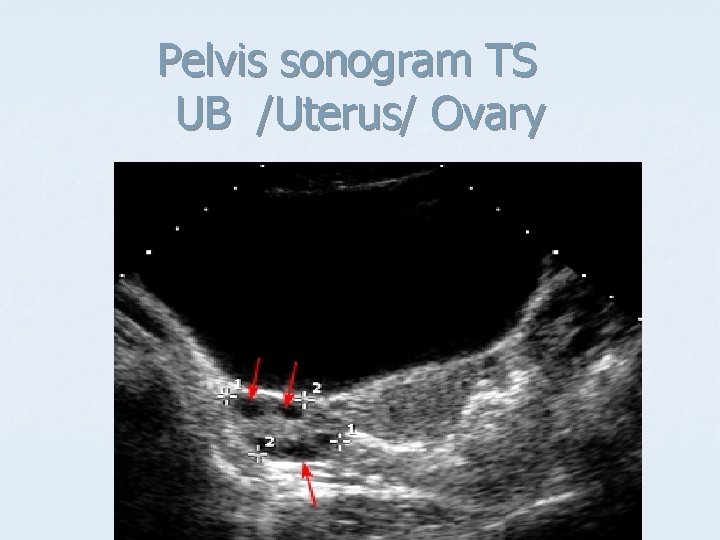 Pelvis sonogram TS UB /Uterus/ Ovary 