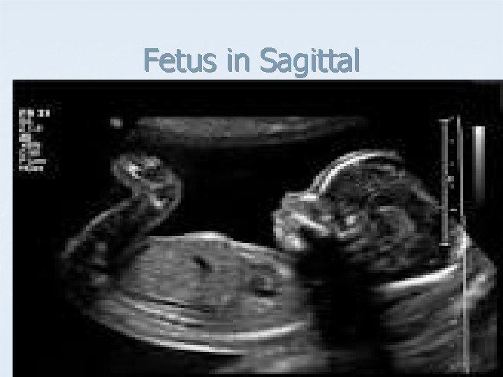 Fetus in Sagittal 