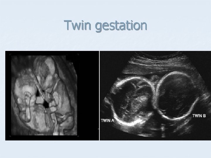 Twin gestation 