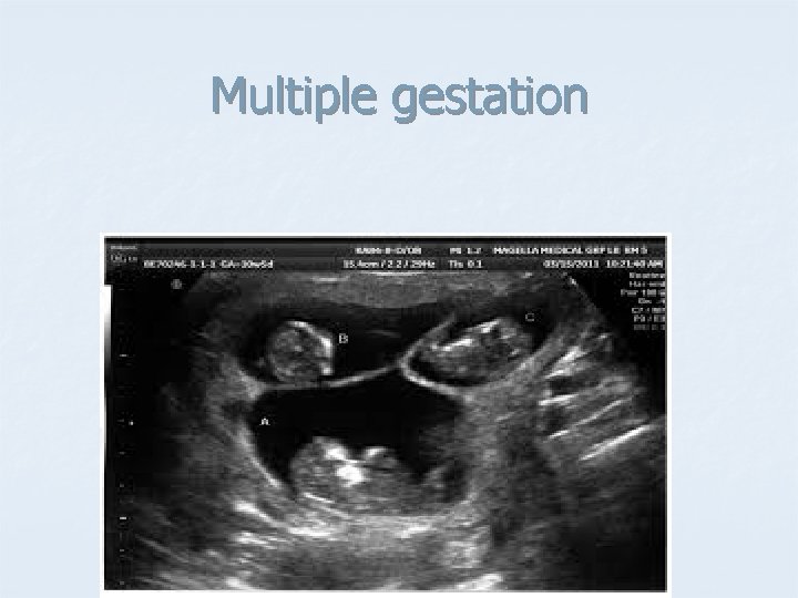 Multiple gestation 