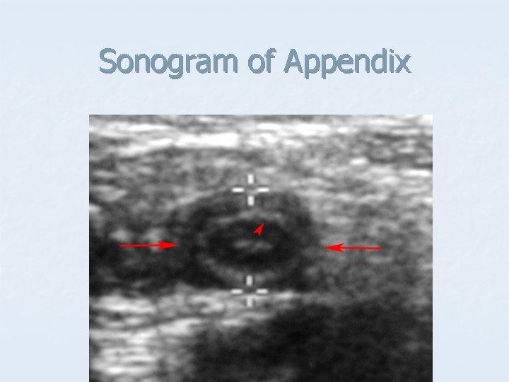 Sonogram of Appendix 