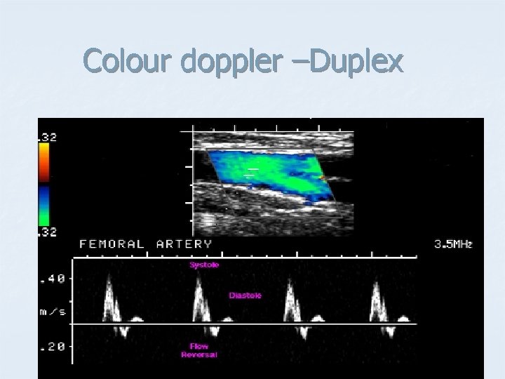 Colour doppler –Duplex 
