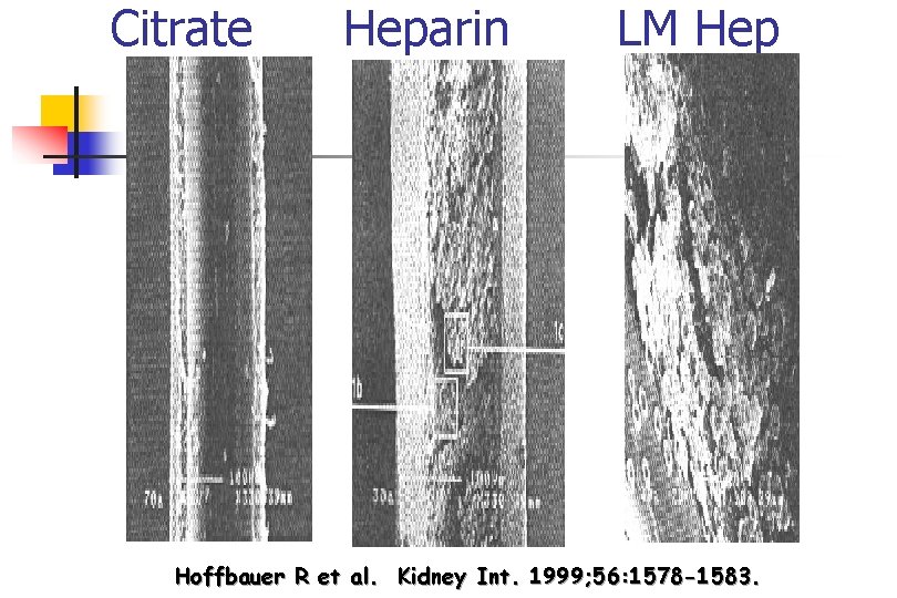 Citrate Heparin LM Hep Hoffbauer R et al. Kidney Int. 1999; 56: 1578 -1583.