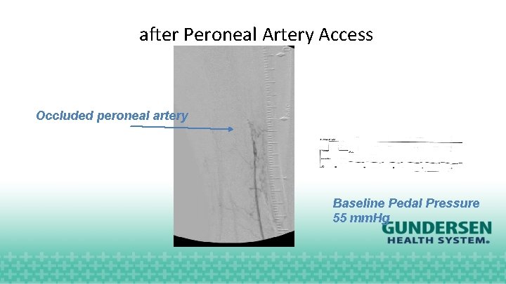 after Peroneal Artery Access Occluded peroneal artery Baseline Pedal Pressure 55 mm. Hg 