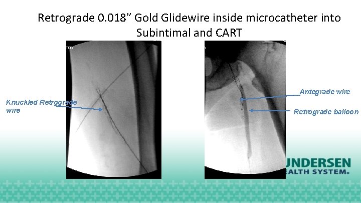 Retrograde 0. 018” Gold Glidewire inside microcatheter into Subintimal and CART Antegrade wire Knuckled