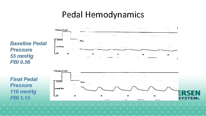 Pedal Hemodynamics Baseline Pedal Pressure 55 mm. Hg PBI 0. 56 Final Pedal Pressure