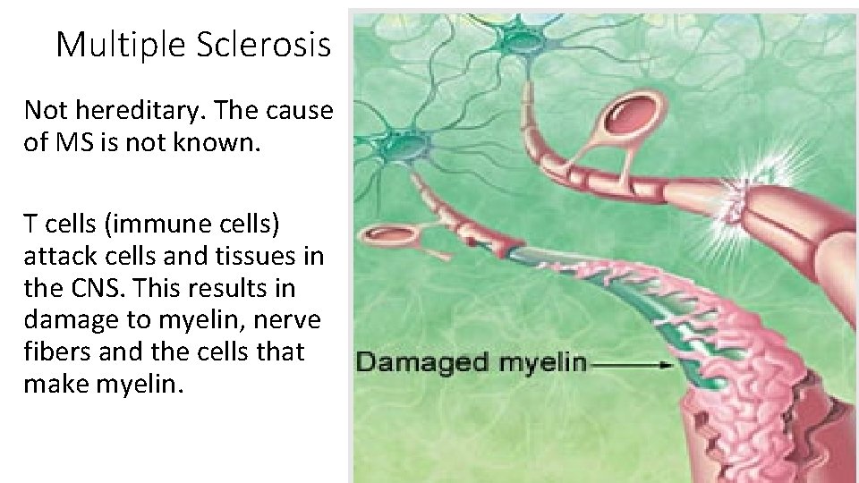 Multiple Sclerosis Not hereditary. The cause of MS is not known. T cells (immune