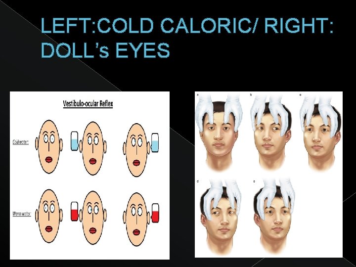 LEFT: COLD CALORIC/ RIGHT: DOLL’s EYES 