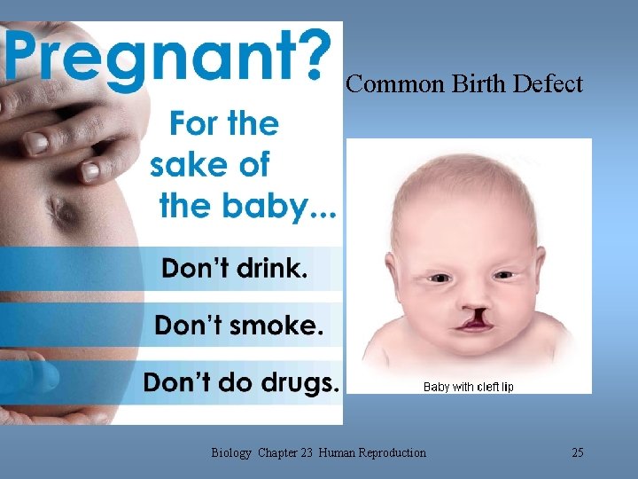 Common Birth Defect Biology Chapter 23 Human Reproduction 25 Common Birth Defect Biology Chapter 23 Human Reproduction 25