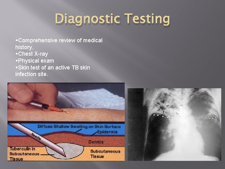 Diagnostic Testing §Comprehensive review of medical history. §Chest X-ray §Physical exam §Skin test of