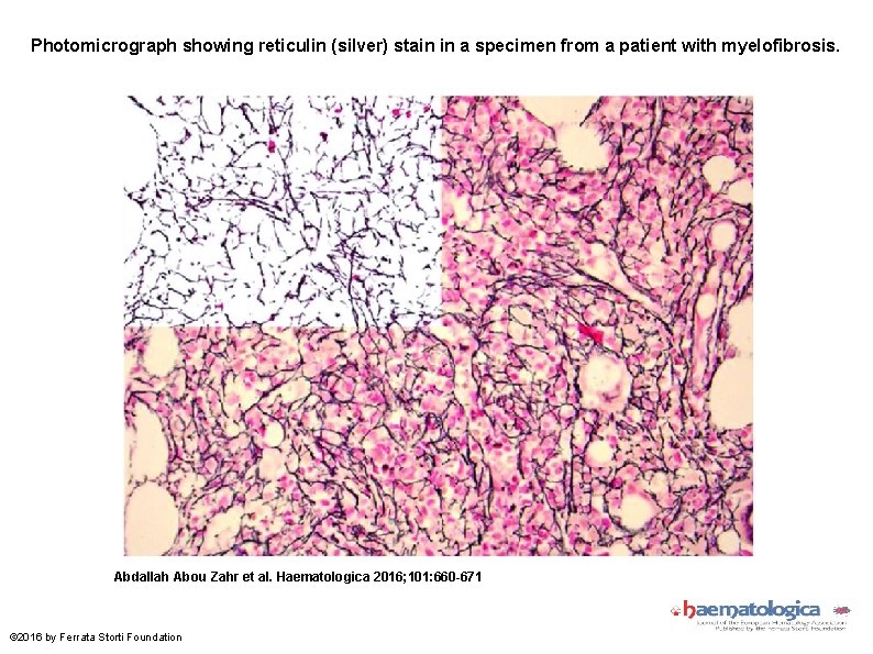 Photomicrograph showing reticulin (silver) stain in a specimen from a patient with myelofibrosis. Abdallah