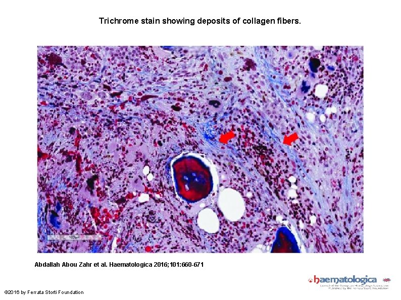 Trichrome stain showing deposits of collagen fibers. Abdallah Abou Zahr et al. Haematologica 2016;