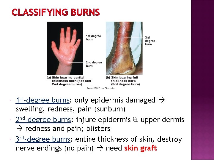 CLASSIFYING BURNS 1 st-degree burns: burns only epidermis damaged swelling, redness, pain (sunburn) 2